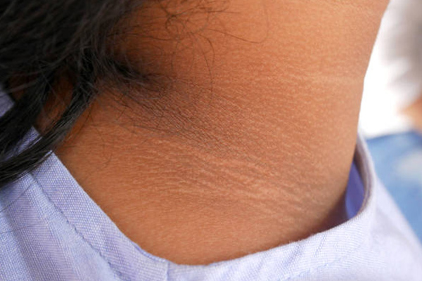 لیزر تیرگی پشت گردن