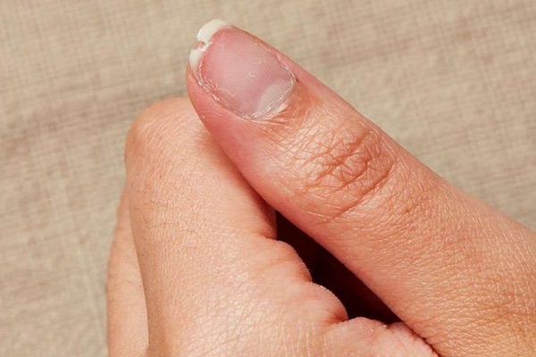 بررسی علت‌های شکستن ناخن 