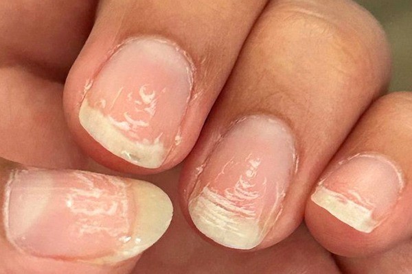 شکنندگی ناخن‌ها به دلیل کمبود ویتامین 