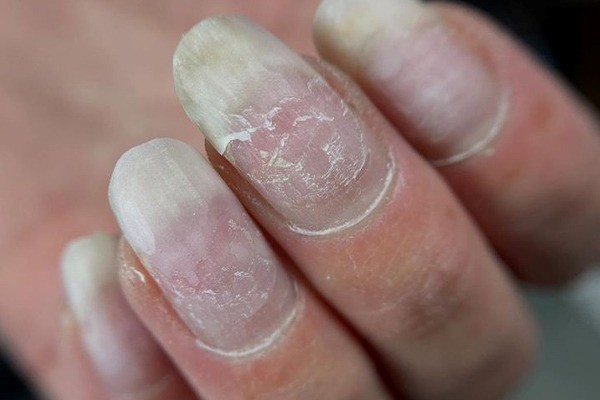 شکستگی ناخن به دلیل بیماری تیروئید