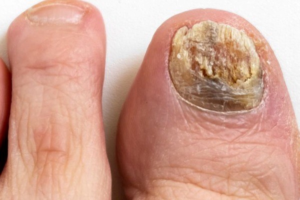 شکنندگی ناخن‌ها به دلیل قارچ ناخن 