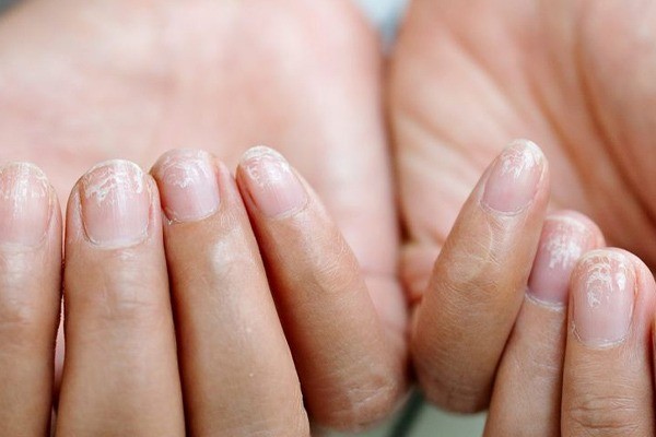 بررسی علت و درمان لایه لایه شدن ناخن 