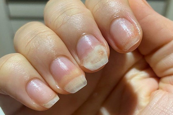 شکنندگی ناخن به دلیل بیماری قارچی