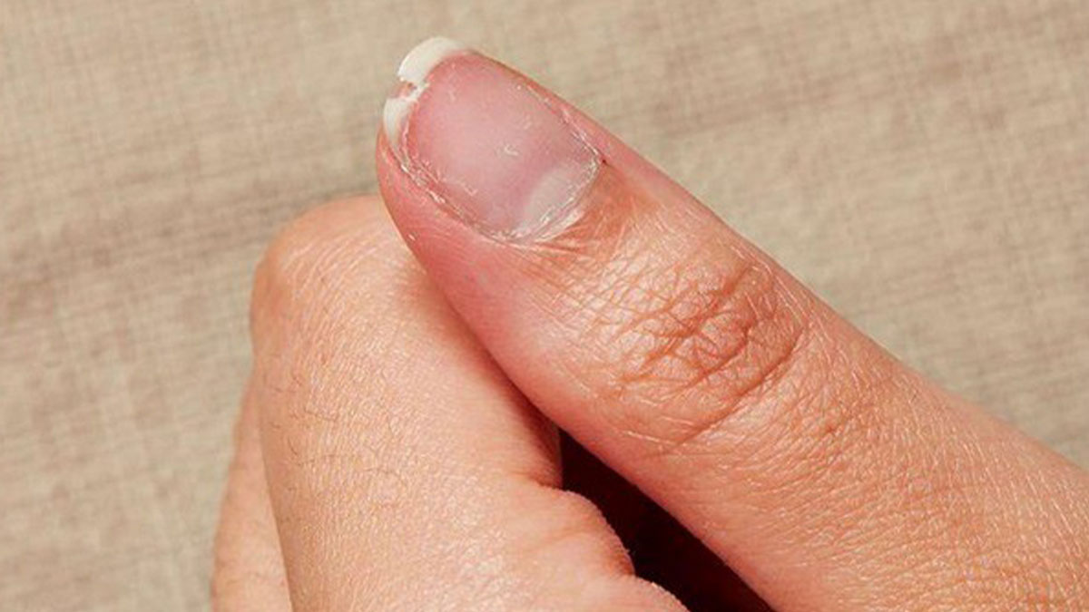 بررسی علت‌های شکستن ناخن 