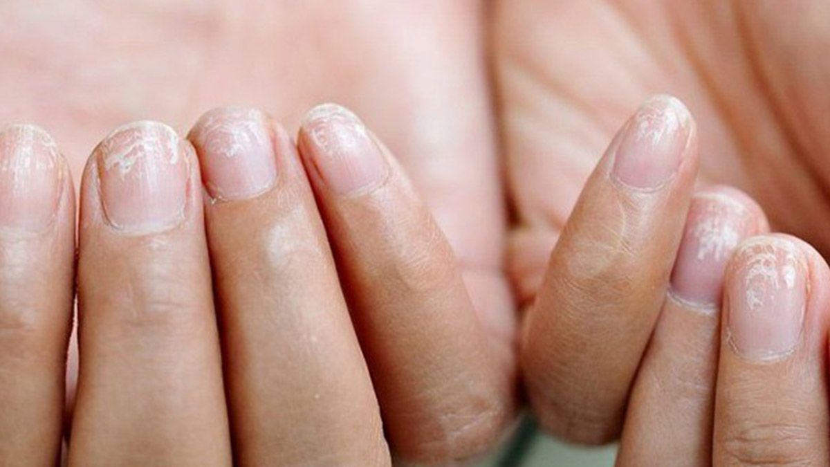 بررسی علت و درمان لایه لایه شدن ناخن 
