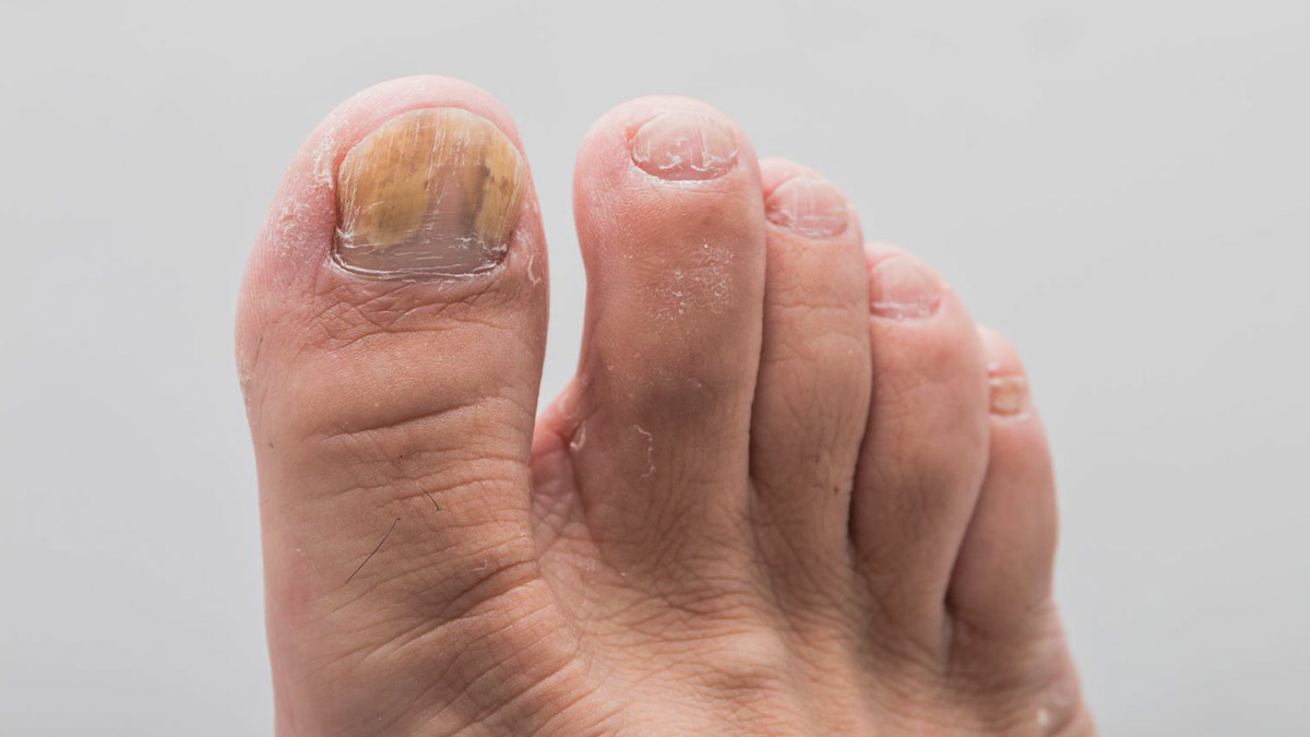 علت تغییر رنگ ناخن شست پا