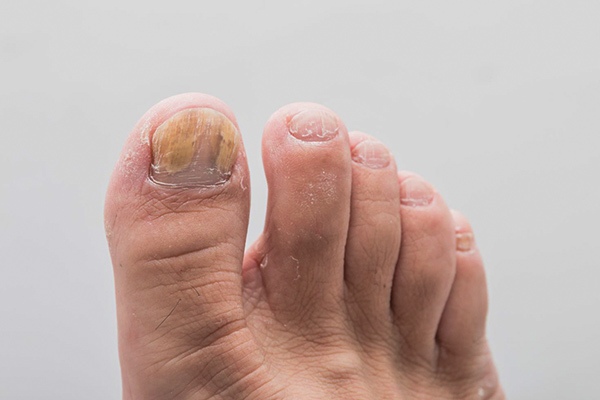 علت تغییر رنگ ناخن شست پا