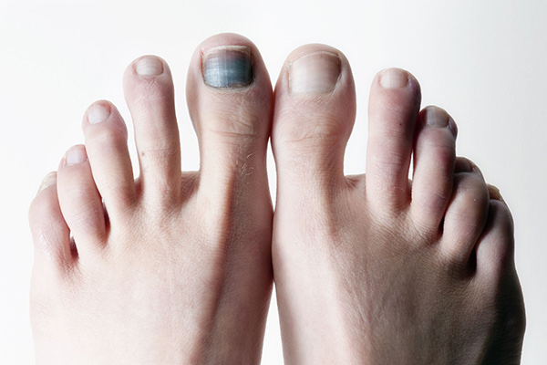 علت کبودی ناخن شست پا