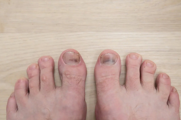 تغییر رنگ ناخن به قهوه ای