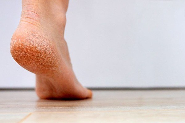 بررسی تاثیر کمبود ویتامین بر ترک پا 