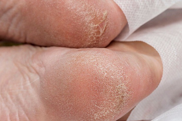 علت ترک پاشنه پا