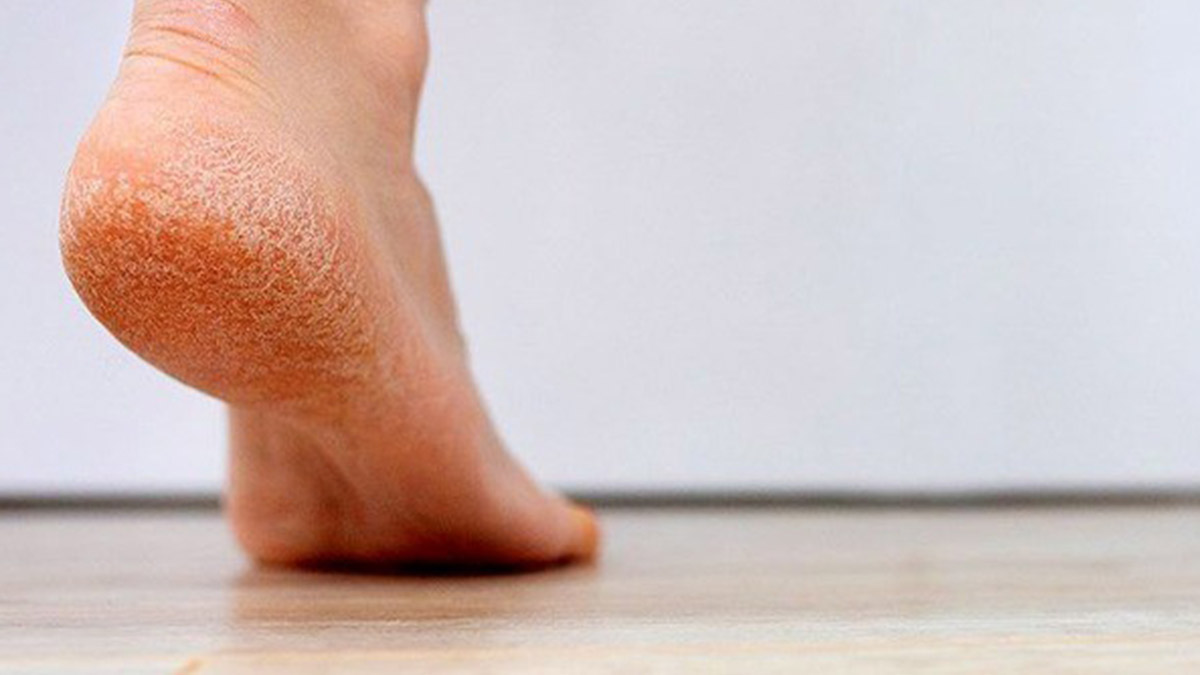 بررسی تاثیر کمبود ویتامین بر ترک پا 