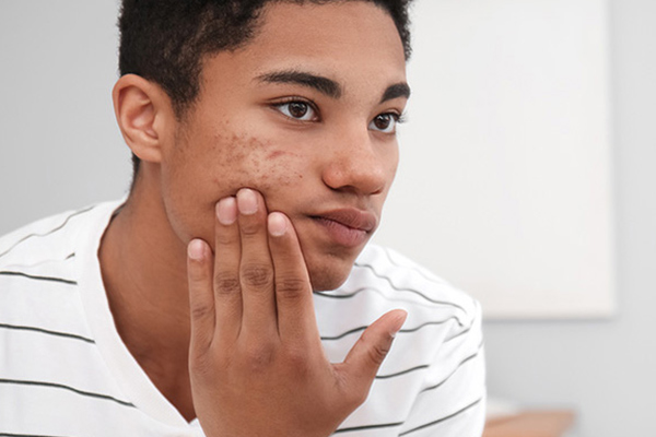 درمان خانگی جوش صورت پسران