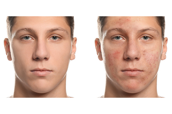 درمان جوش بلوغ پسران