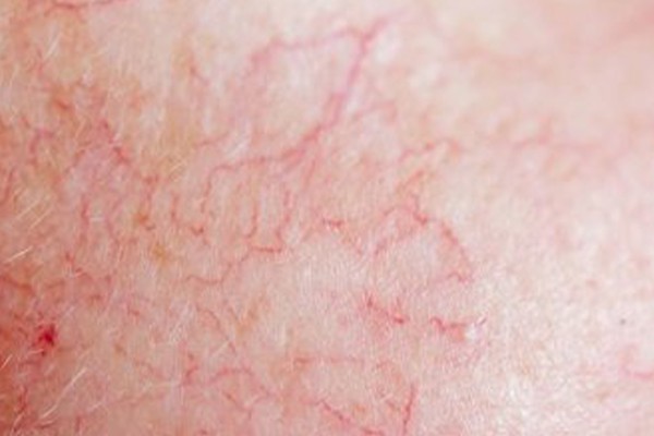 عوارض استفاده از نوره