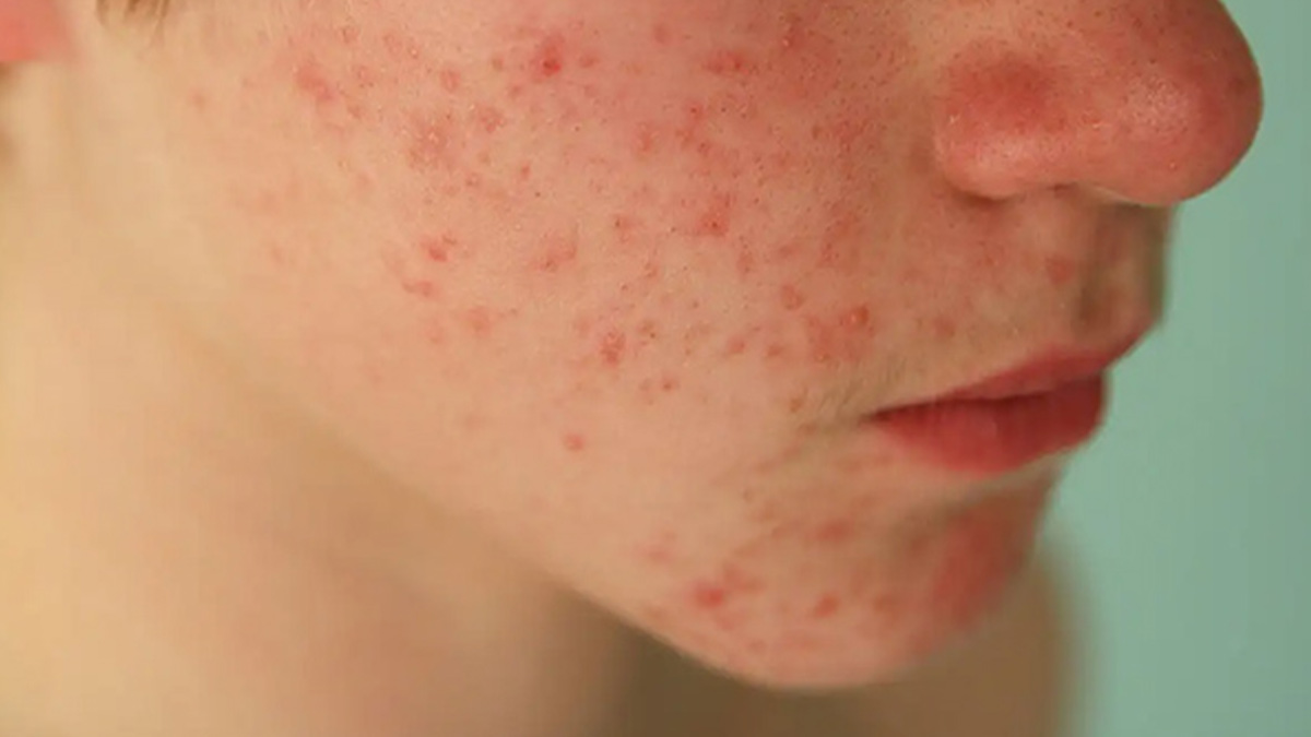 از بین بردن سریع جوش بعد از اصلاح