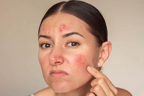 علت جوش بعد از اصلاح صورت