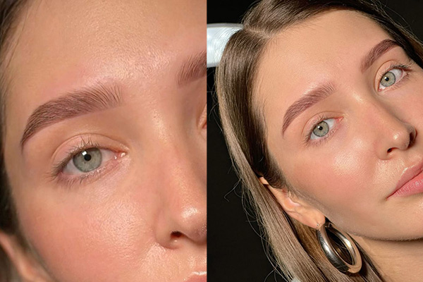 فیبروز ابرو بعد از یک هفته